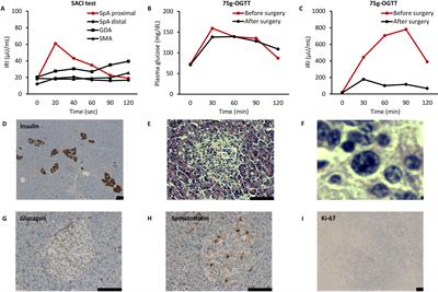 Case report: Duplication of the GCK gene is a novel cause of nesidioblastosis: evidence from a case with Silver-Russell syndrome-like phenotype related to chromosome 7